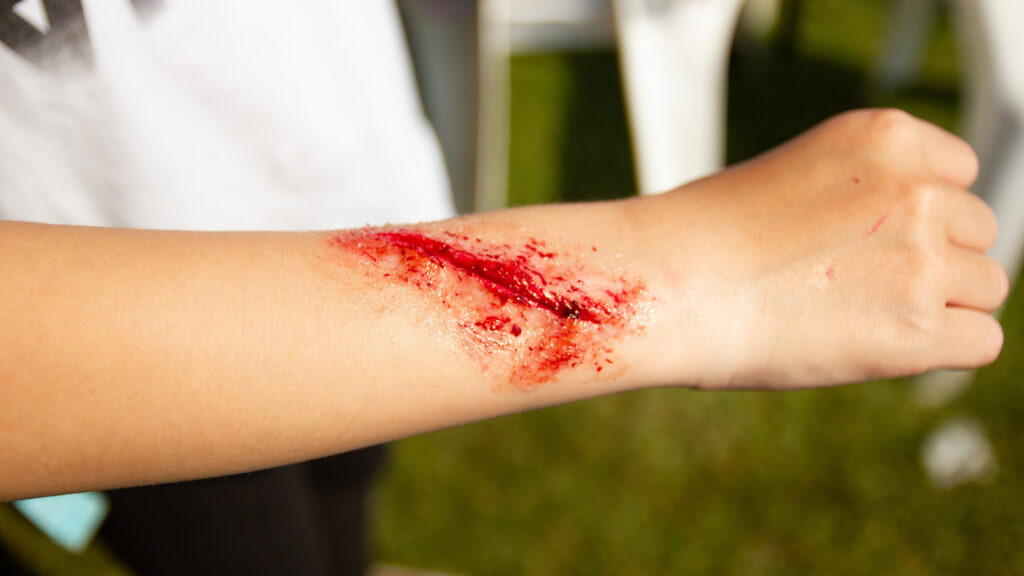 Understanding the Basics What Your Wound Needs to Heal