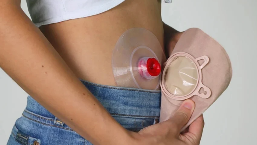 Preparing to Empty a Colostomy Bag at Home