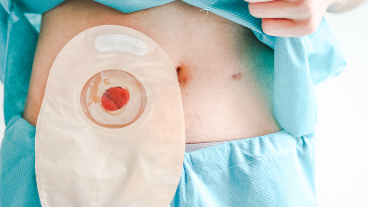 How to Empty a Colostomy Bag at Home Safely