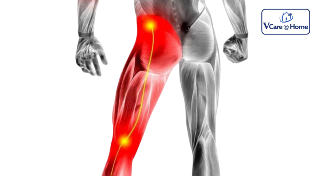 What is Sciatica?